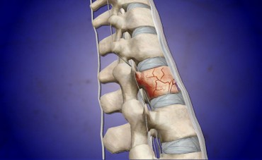 Osteoporosis 3d.jpg